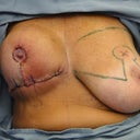During reduction sugery