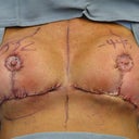 During surgery