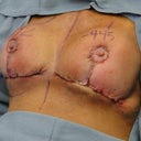 During surgery