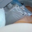Love handles treated with the small filter