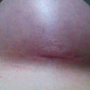 scar 7 weeks