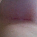 scar 7 weeks