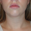 8 Weeks Post - Front