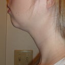 8 Weeks Post - Left