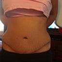 Two month post op!