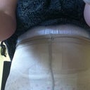 day 6, front view was all i could manage taking the photo with my mobi by myself, also hips very swollen due to the lipo