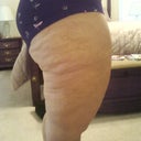 Side shot BEFORE the surgery