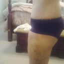 (12 days after surgery) Side shot AFTER the surgery. The thickness of the front of my leg is all gone.  19#s gone!  But still VERY swollen