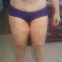 (12 days after surgery) Told you it was all gone now! lol  PS says if Im happy now, that I'll be unreal happy in a few more weeks when swelling is all gone. All that flab is gone from my inner thighs and  no more saddlebags!!!!