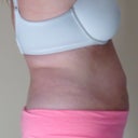 13 DAY POST OP---NOT liking this view at all....ughhhh