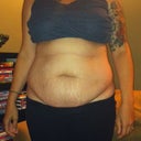 2 days pre-op. So embarrassing! Ugh. I could hide it well in jeans though. I know I won't be getting rid of the majority of stretch marks, but I will take what I can get.