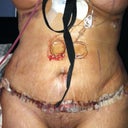 Day after surgery. Still a lot of stretch marks and I really swollen and bruised, but so far I am happy.