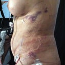 Day after surgery. Not as impressed with the side shot as the front one. Hoping that the bulging is just from swelling.