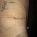 13 Days post op