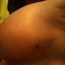 the incision on the square side L; implant is still high and hope it fills out!