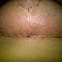 3 wks post op- Left breast underside. Healing really well.