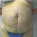 Before any procedures at all. This was 2/15/2012. Weight on this day was 174