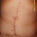 9 months post op. That thing in the center is my new bellybutton.