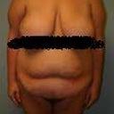 PreOP1 front view