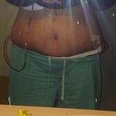 14 Days post op