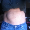 5 months post op