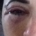 Right eye.  Far worse than the left.  Major scar under this eye that extends beyond my eye.  Flared scars with 'dog ears'  Scar pops up at the end of incision lines.  Make-up cannot cover.