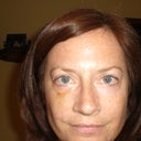 7/18/2012  1 week after radiesse injections.  Things look good except for bruising.  You can see a circular dot under the right eye on top of cheek.  Hoping this will all go away.  Dr. did inject a lot more in right than left cheek.