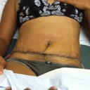 1 week po scar still rough, belly looks ok