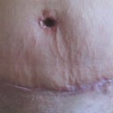 My scar 20 day PO.