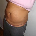 results after 2 procedures