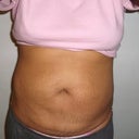 4 mths after 2nd procedure