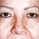 Blepharoplasty