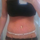 7 days post op