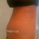7 days post op - SWOLLEN!!