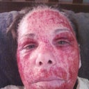 Just got home after procedure and am lying in bed.