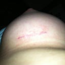 Incision on Day 30