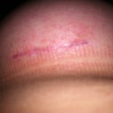Right Breast Incision Day 30