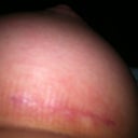 Left Breast Incision Day 30