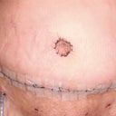 8/14/11 5 days PO & still very swollen, but very happy!