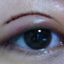 3 days after surgery