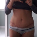 PO 21 Days - Scar is fading some, can't wait to start scar therapy though!