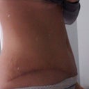 PO 21 Days - Side Scar.  You can see the swelling towards the bottom of the scar...
