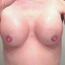 13 Days Post op - front shot