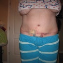 12 weeks / 3 months P/O