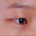 Double Eyelid Surgery Should Be Taken With Forehead & Eyebrow Lift