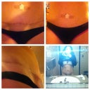The belly and scar.  Notice Belly button still bandaged up =0(