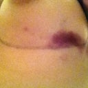 DAY OF POST OP - Crazy bruising. I have this on both sides