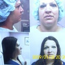After pics taken by MD. only 2 days post op!!Right after bandages removed. Some swelling but really no brusing at all!
