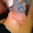 Incision