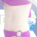 One week later.  Still swollen but I'm thrilled w results